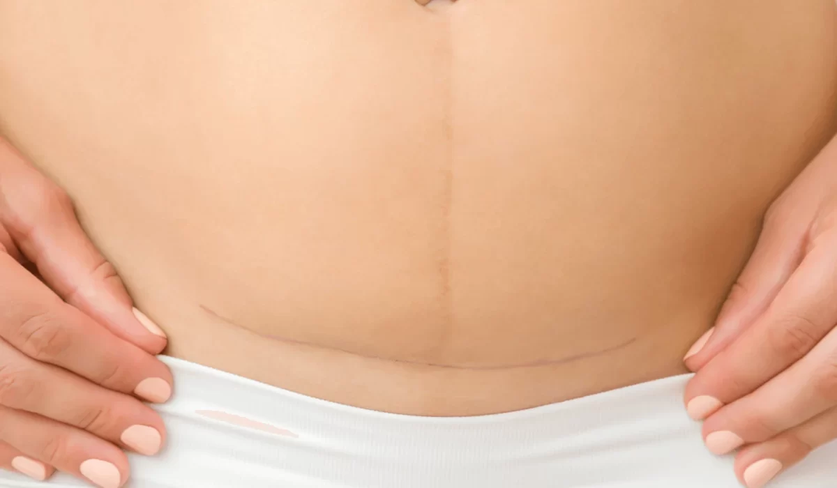 Understanding and Healing C-Section Scars